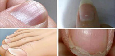 Common Nail Conditions Linked to Serious Diseases That You Shouldn’t Ignore