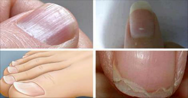 Common Nail Conditions Linked to Serious Diseases That You Shouldn’t Ignore