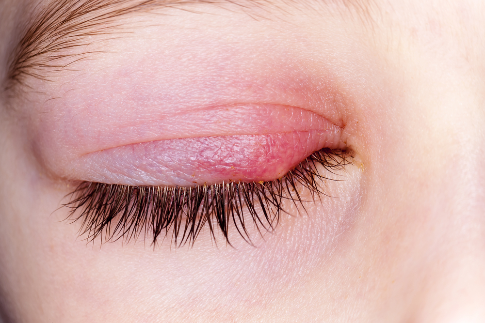 Blepharitis and Fibromyalgia