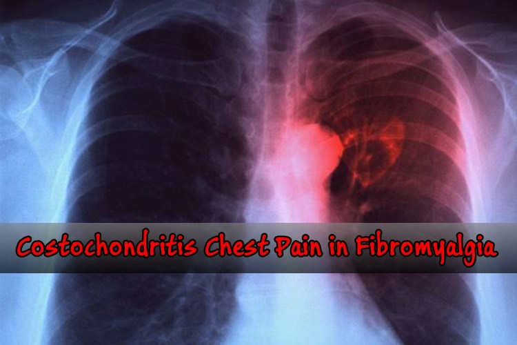 Should You Worry About Costochondritis Pain in Fibromyalgia?