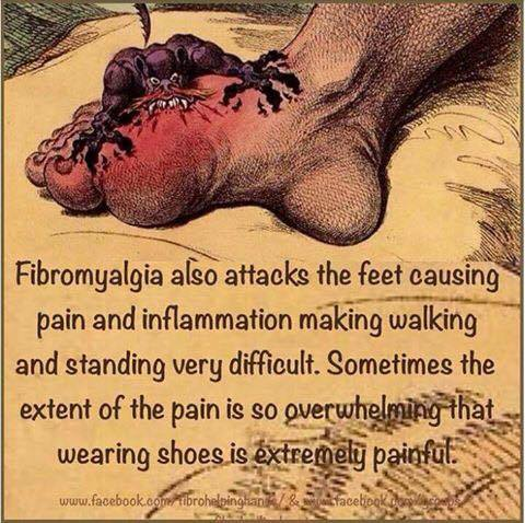 Foot Pain in Fibromyalgia and its Relief