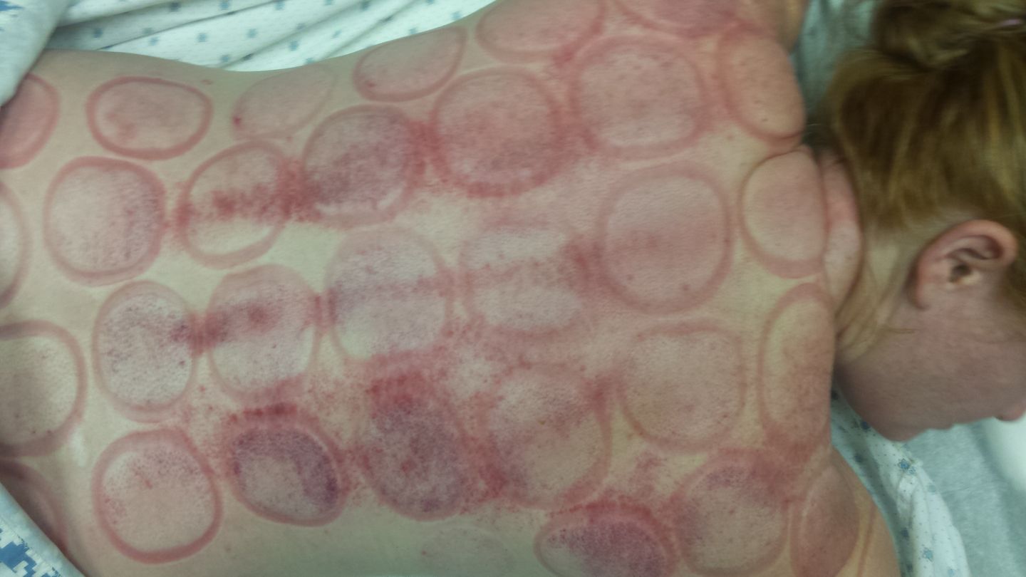 Can cupping therapy relieve fibromyalgia???