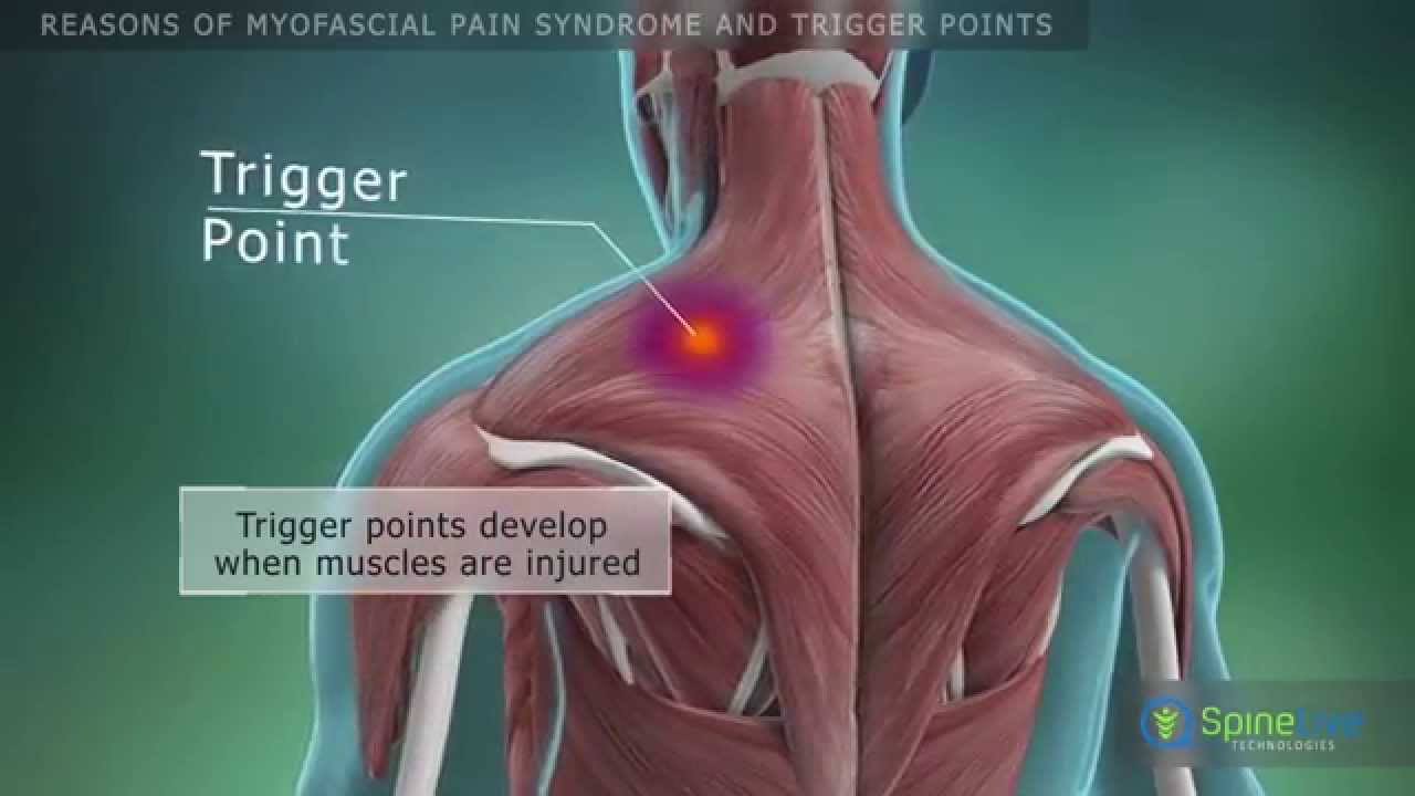 Myofascial Pain Syndrome and Fibromyalgia