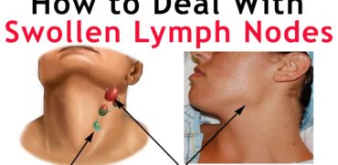 Lymph Nodes or Swollen Glands with Fibromyalgia & ME/CFS