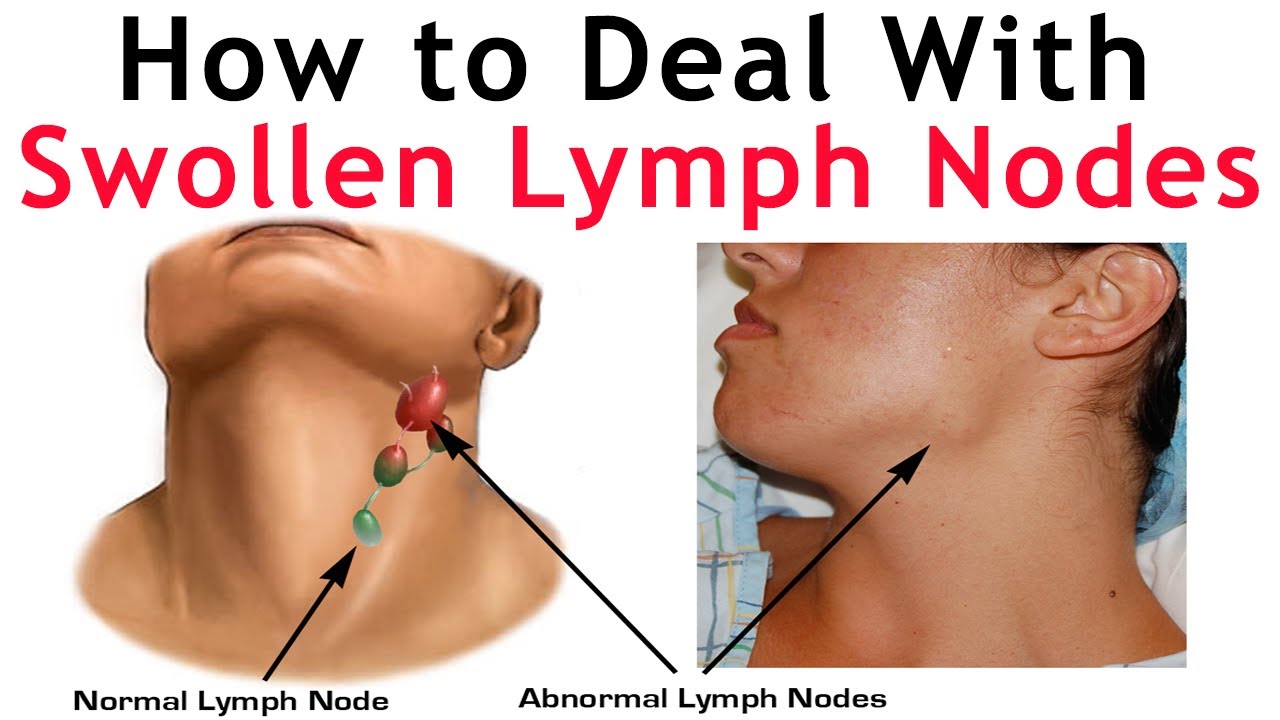 Swollen Glands or Lymph Nodes with Fibromyalgia & ME/CFS