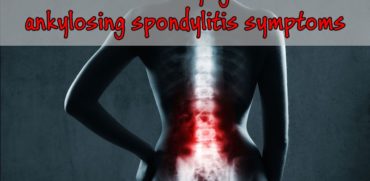 Fibromyalgia Intensifies Ankylosing Spondylitis Symptoms