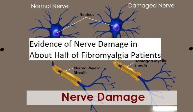 Evidence of Nerve Damage in about Half of Fibromyalgia Patients