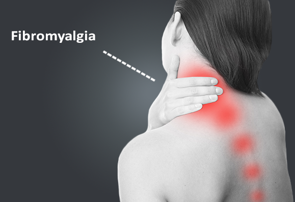 7 Strange and Weird Signs of Fibromyalgia