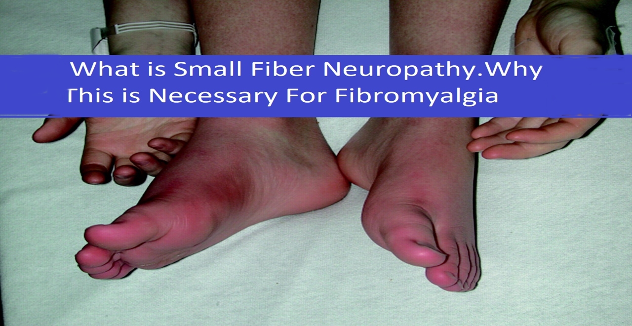 Small Fiber Neuropathy in Fibromyalgia and CFS