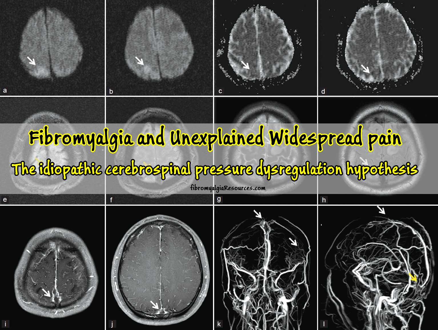 Fibromyalgia and Unexplained Widespread pain:The idiopathic cerebrospinal pressure dysregulation hypothesis