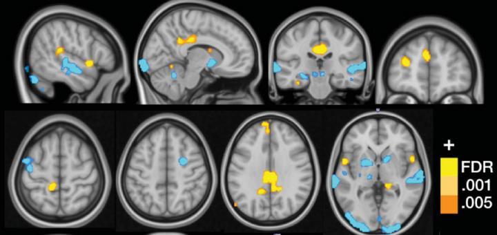 Neural Signature for Fibromyalgia May Aid Diagnosis, Treatment