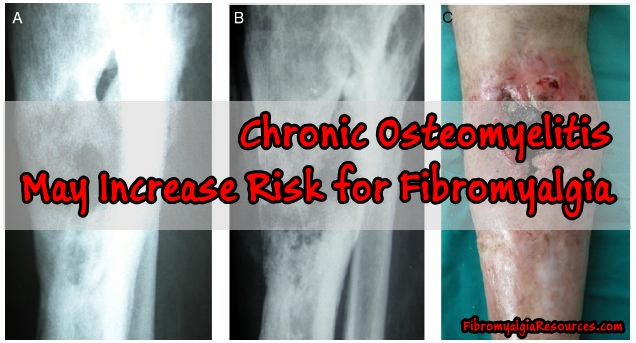 Chronic Osteomyelitis May Increase Risk for Fibromyalgia