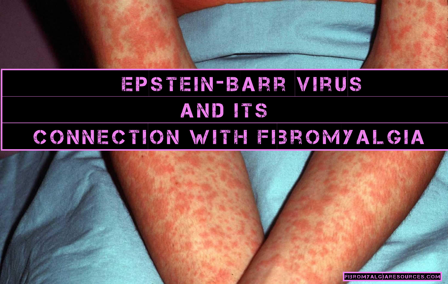 EBV Is The Possible Cause Of Fibromyalgia, Research