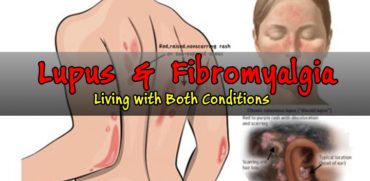 Lupus? How it is connected with Fibromyalgia