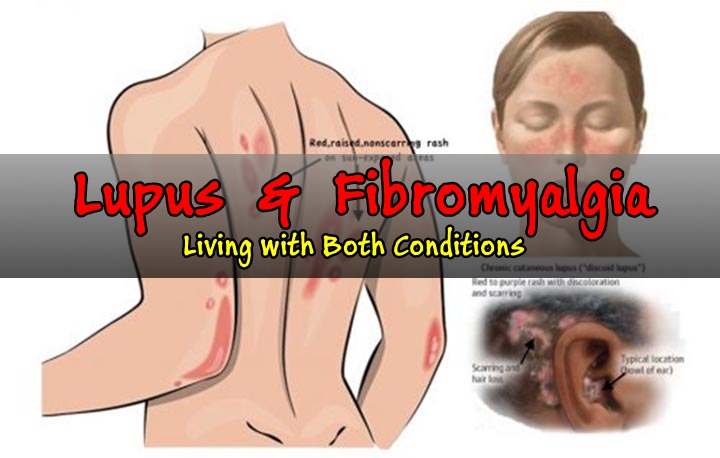 What is Lupus? How it is connected with Fibromyalgia