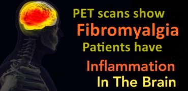 PET Scans show Fibromyalgia Patients have Inflammation in the Brain