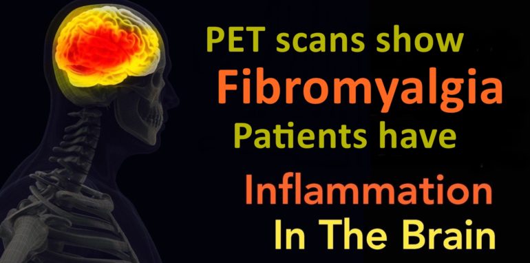 PET Scans show Fibromyalgia Patients have Inflammation in the Brain