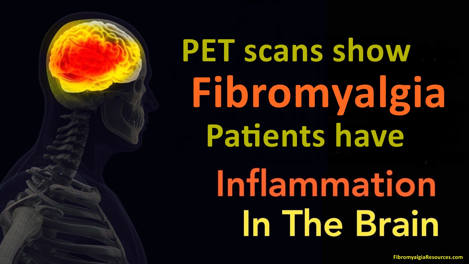 PET Scans show Fibromyalgia Patients have Inflammation in the Brain