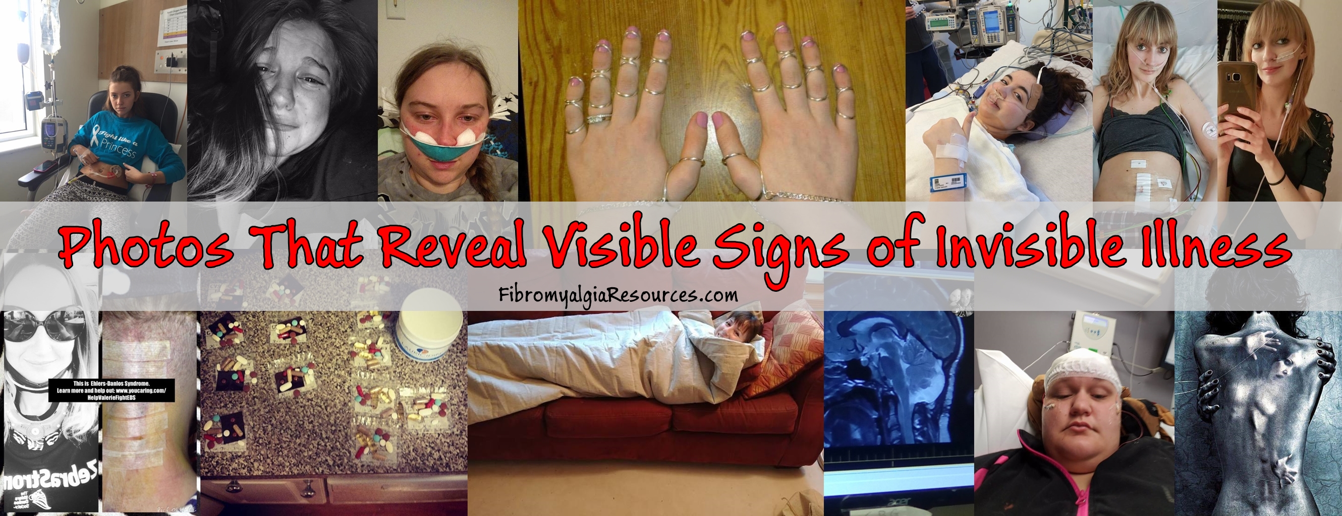 20 Photos that Reveals the Visible Aspect of “Invisible” illness